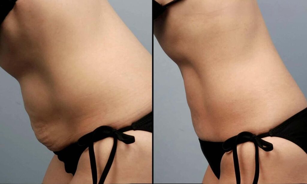 liposuction-before-and-after-gallery-patient-photo-1