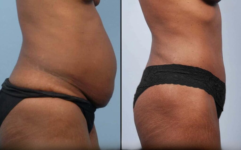 liposuction-before-and-after-gallery-patient-photo-13