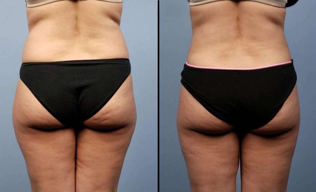 liposuction-before-and-after-gallery-patient-photo-16