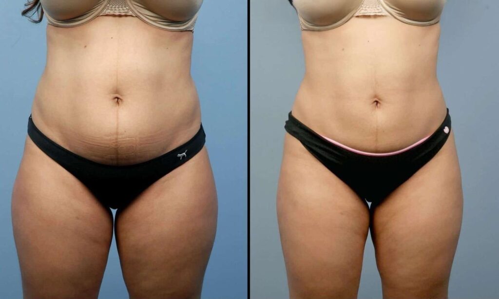 liposuction-before-and-after-gallery-patient-photo-17