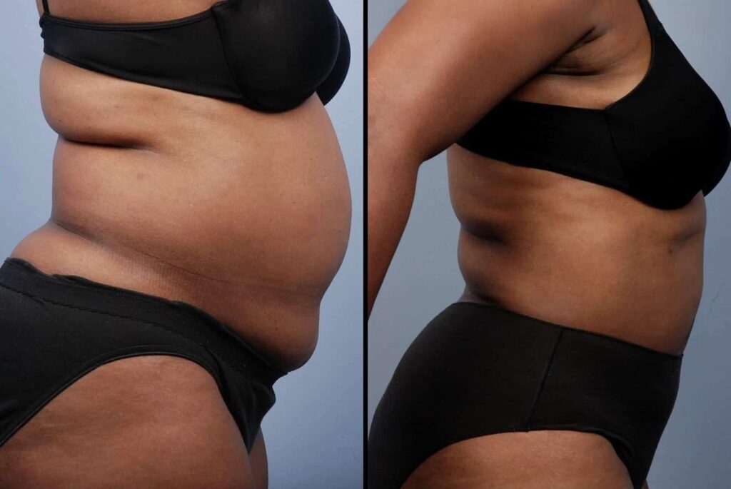 liposuction-before-and-after-gallery-patient-photo-19