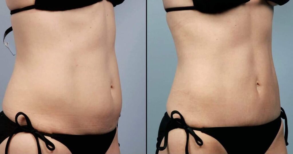 liposuction-before-and-after-gallery-patient-photo-2