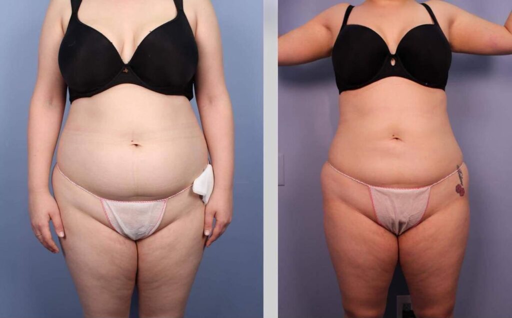 liposuction-before-and-after-gallery-patient-photo-25