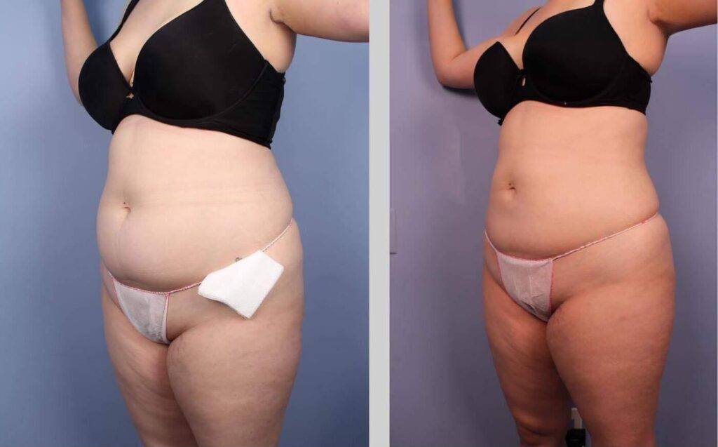 liposuction-before-and-after-gallery-patient-photo-26