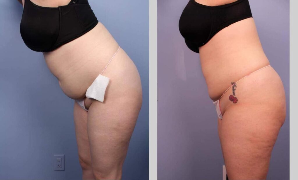 liposuction-before-and-after-gallery-patient-photo-27