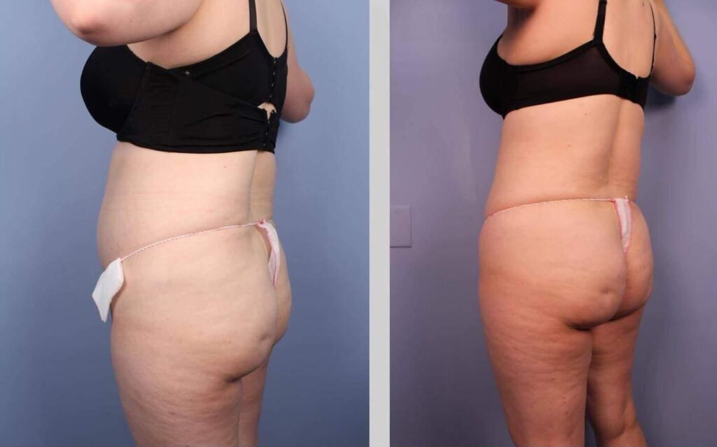 liposuction-before-and-after-gallery-patient-photo-28