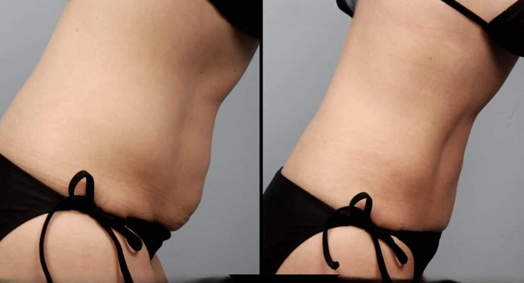 liposuction-before-and-after-gallery-patient-photo-3
