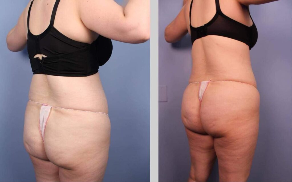 liposuction-before-and-after-gallery-patient-photo-30