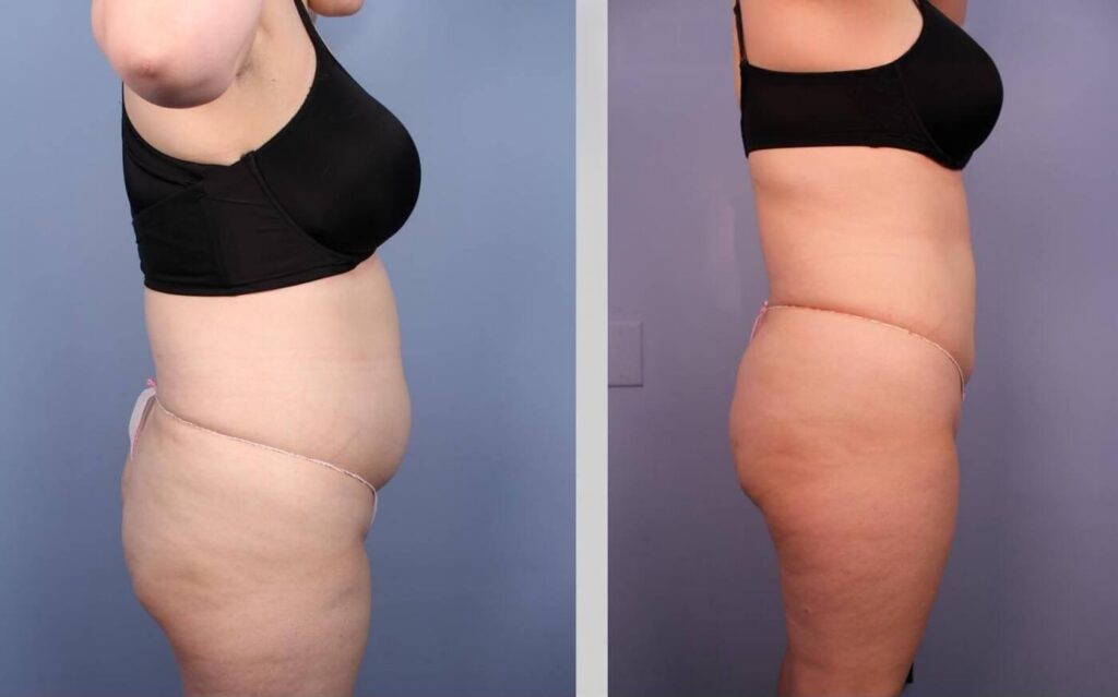 liposuction-before-and-after-gallery-patient-photo-31