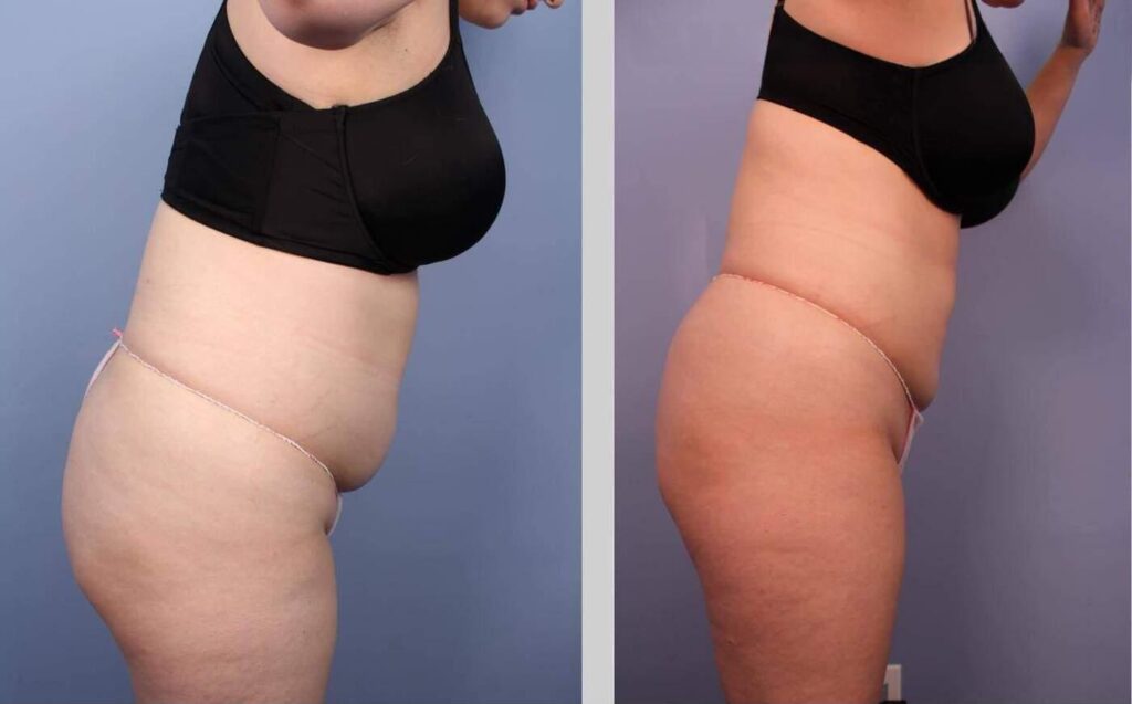 liposuction-before-and-after-gallery-patient-photo-32