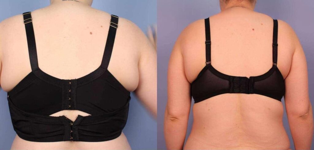 liposuction-before-and-after-gallery-patient-photo-33