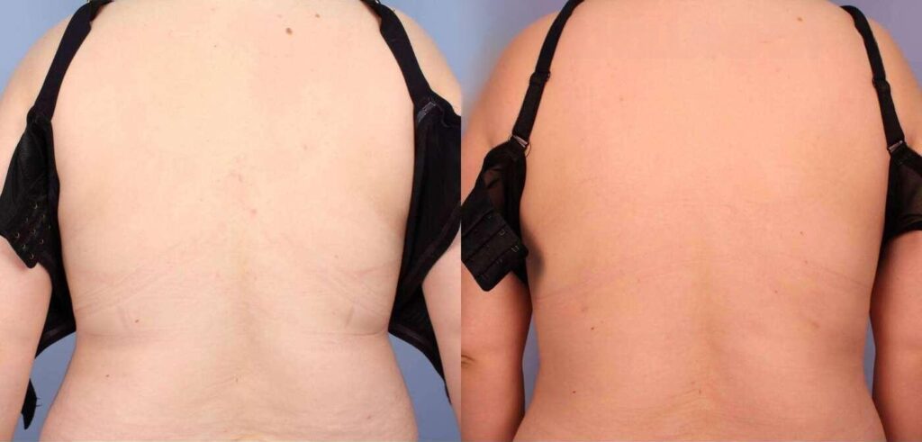 liposuction-before-and-after-gallery-patient-photo-34