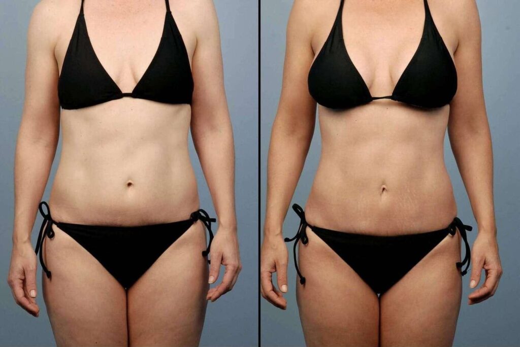 liposuction-before-and-after-gallery-patient-photo-4