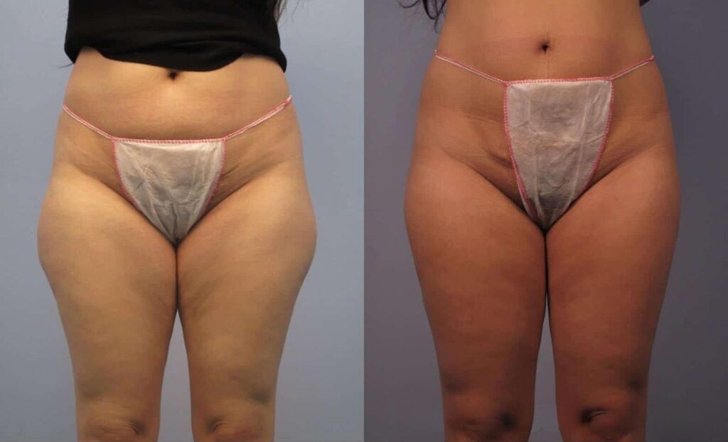 liposuction-before-and-after-gallery-patient-photo-53