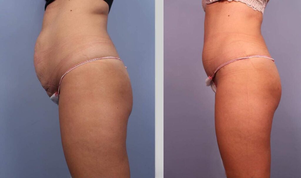 liposuction-before-and-after-gallery-patient-photo-9